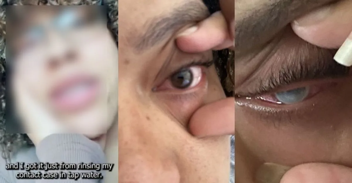contact lens hygiene