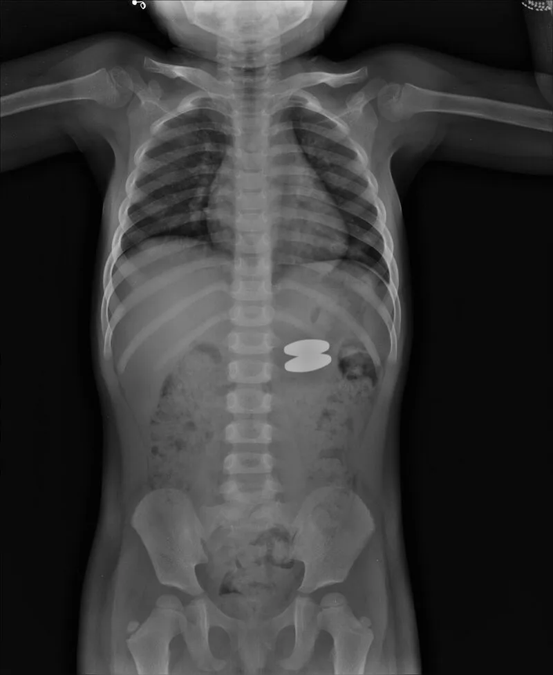 foreign body ingestion