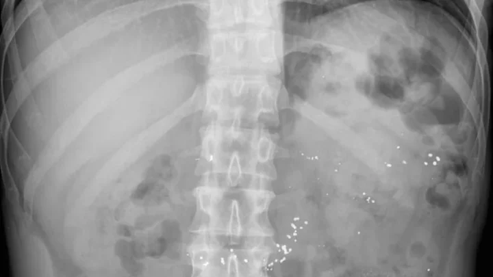 What Really Happens If You Swallow Glass?
