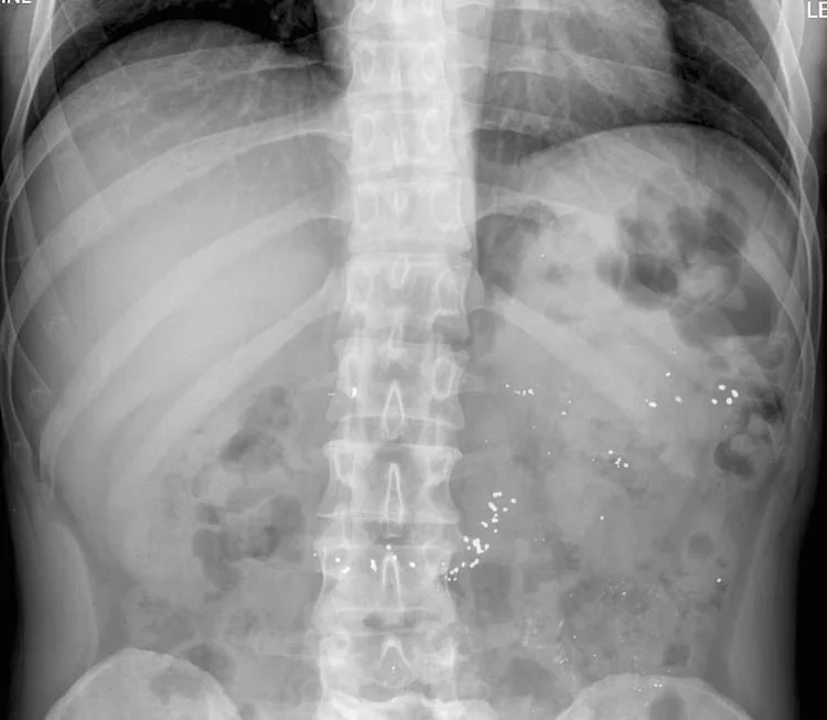 what happens if you swallow glass